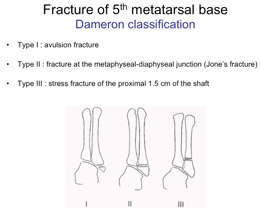 Figure 5 for case Fifth metatarsal base injuries